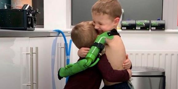 Tras recibir una prótesis hidraúlica, pudo abrazar a su hermano ¡por primera vez!